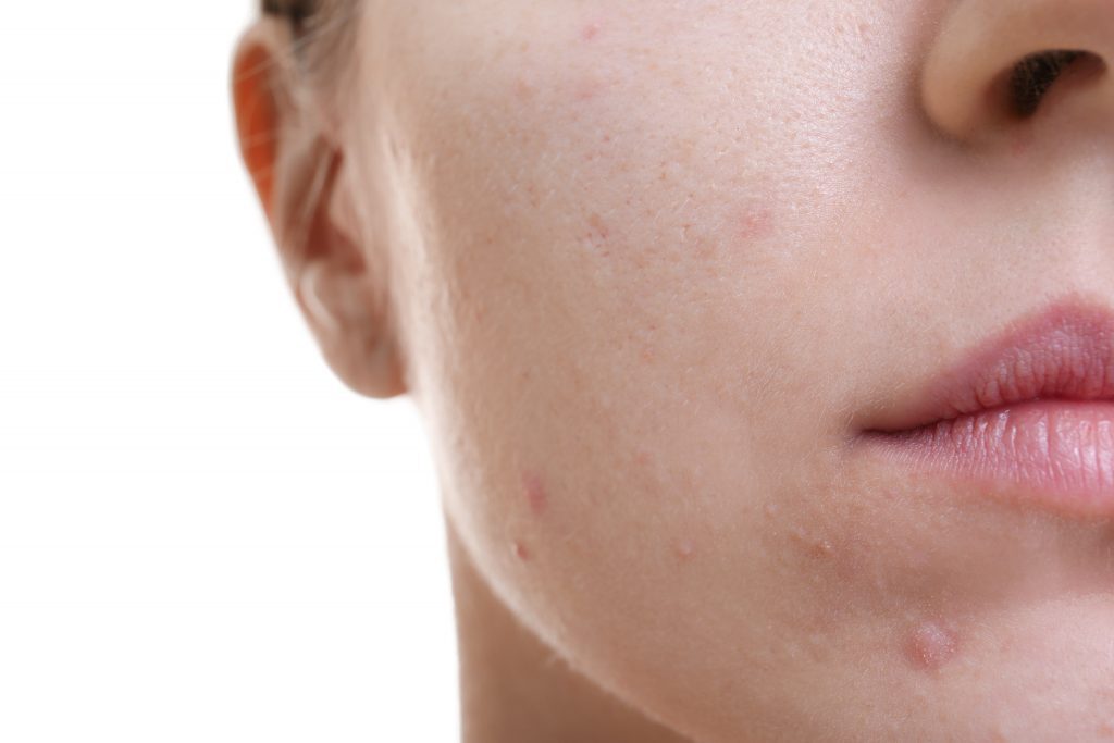 Acne Vulgaris on the face of a young lady.