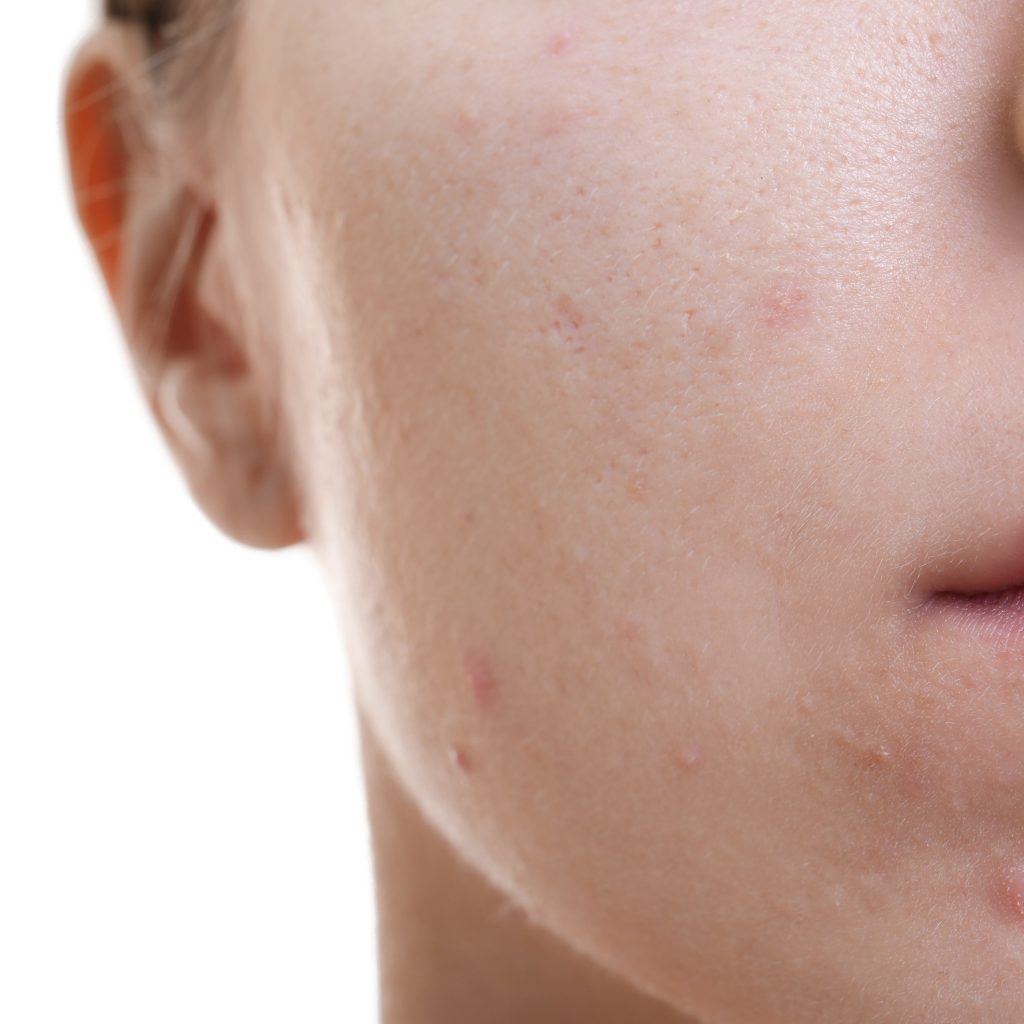 A young lady suffering from Acne Vulgaris.