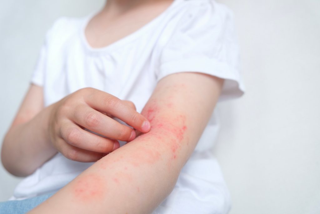 Demonstrates a young child with eczema,itchy red scaly patches on the skin.