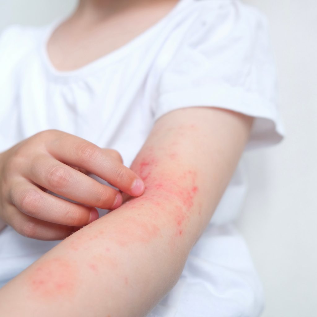 A young child suffering from eczema.