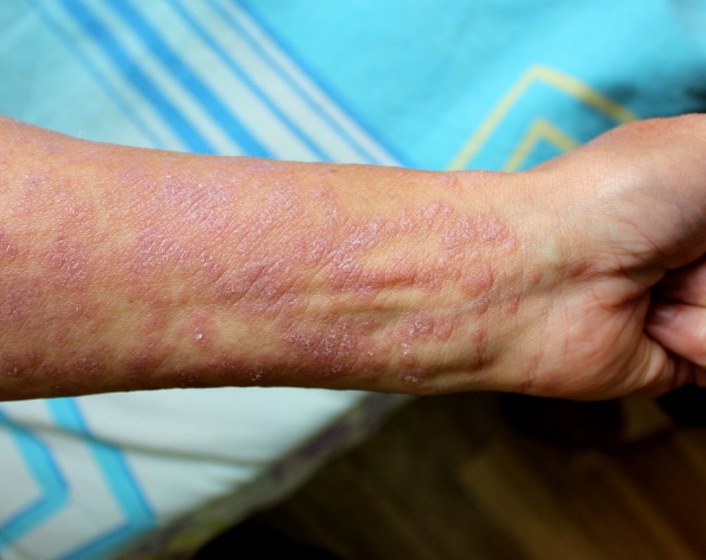 Lichen plants on the wrist of a patient.
