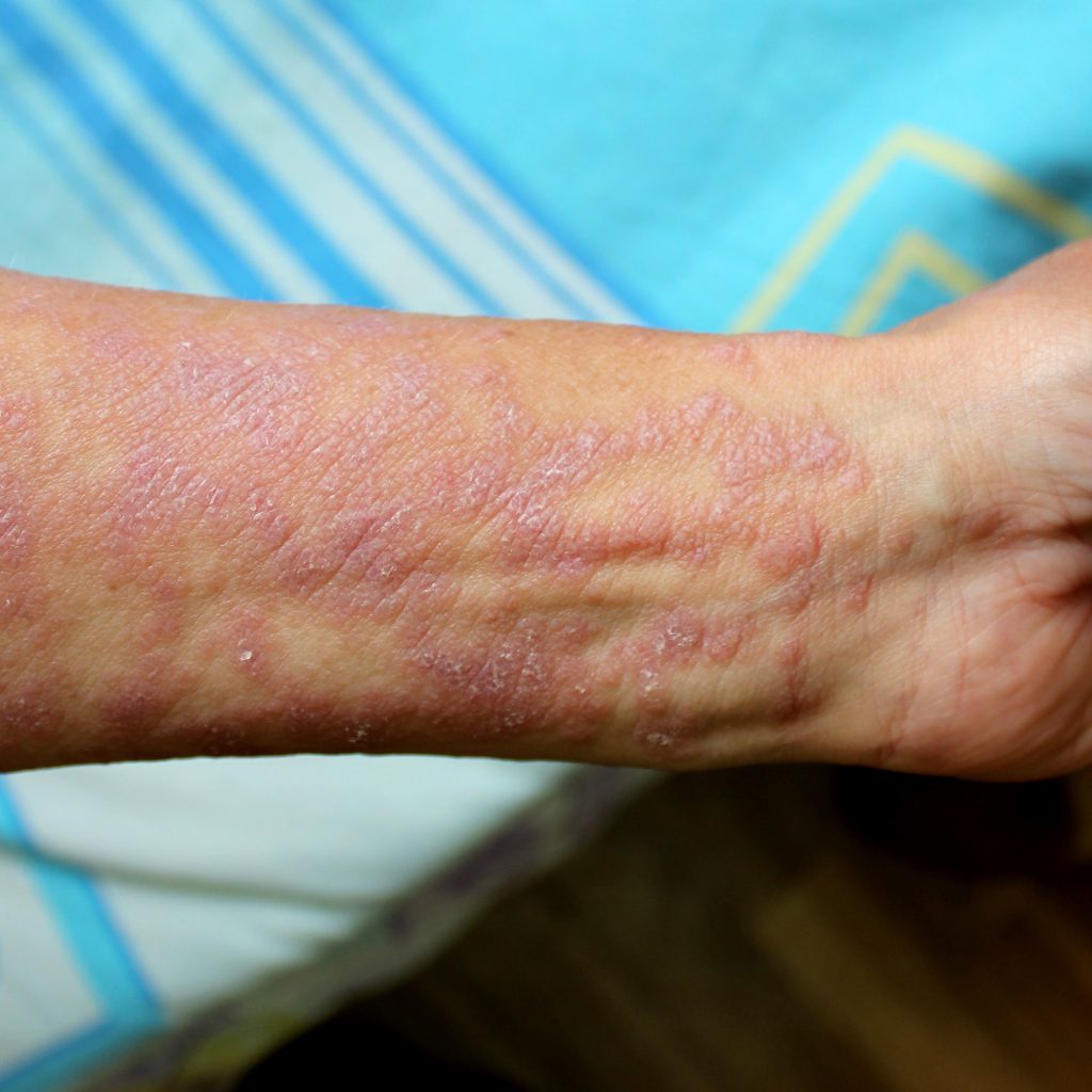 The wrist of a patient with a skin condition called lichen plants. Red scaly itchy papule and plaques.