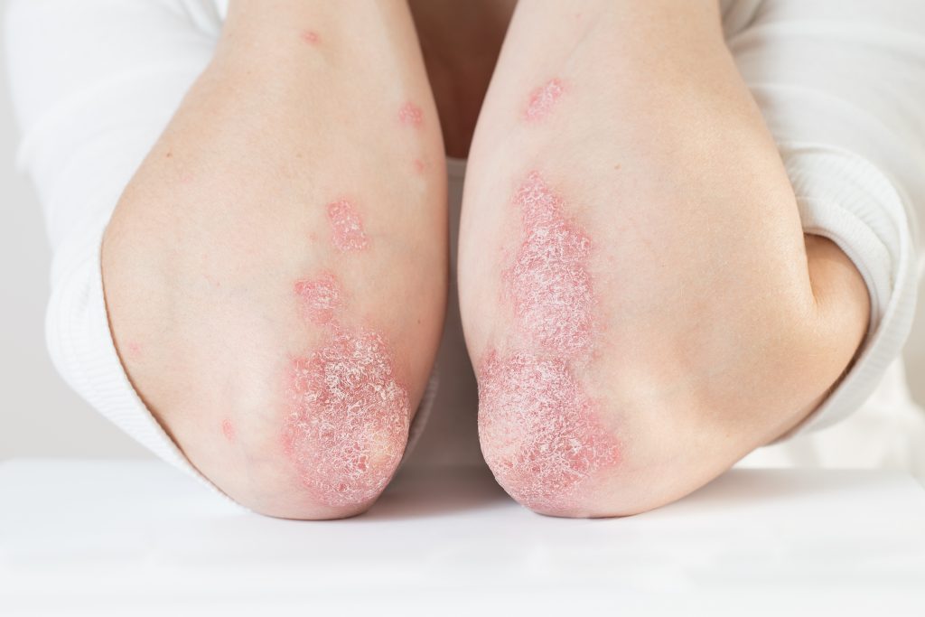 Red scaly plaques on the elbows of a patient with acute Psoriasis.