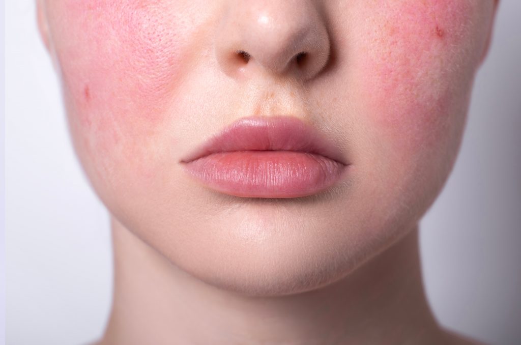 Photo shows the red face of a young lady suffering from Rosacea.