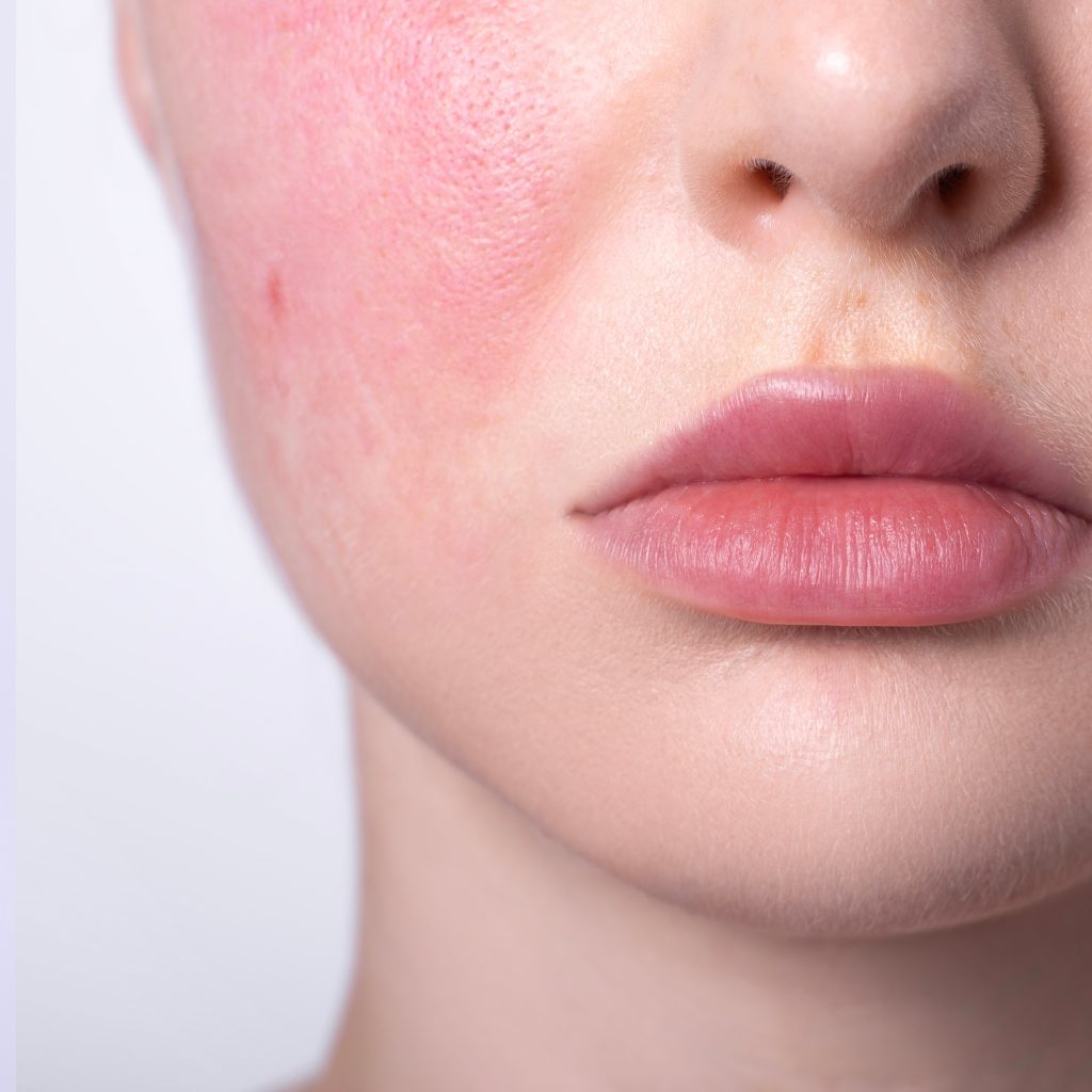 Photo shows a young woman with a red face, a condition called Rosacea.