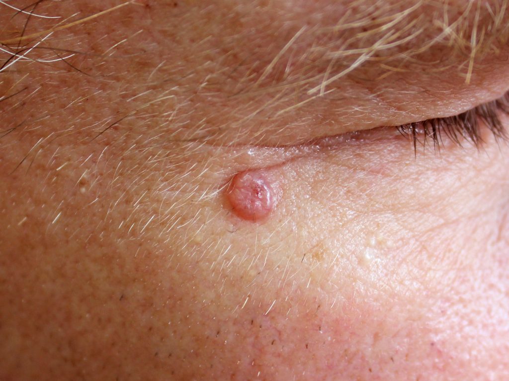Photo shows a facial skin cancer called Basal Cell Carcinoma.