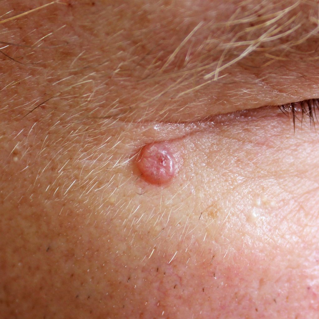 Photo shows a Basal Cell Carcinoma, a common skin cancer on the face of a patient that Dr.Jonathan Slater treats.