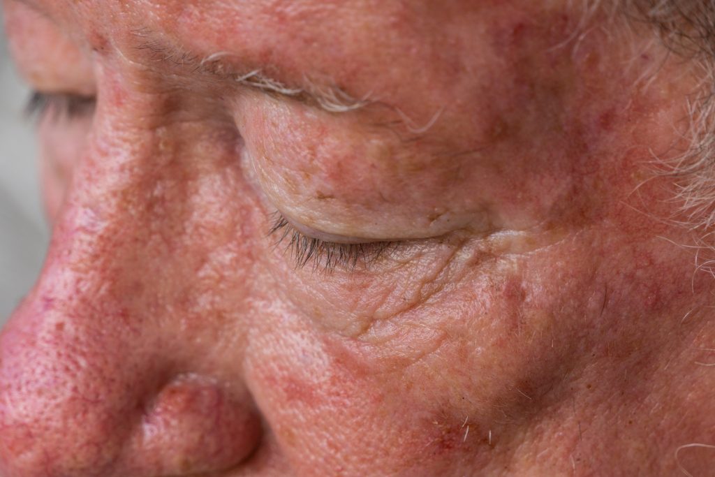 Photo shows the face of an elderly gentleman with sun damaged skin requiring treatment for skin cancer.