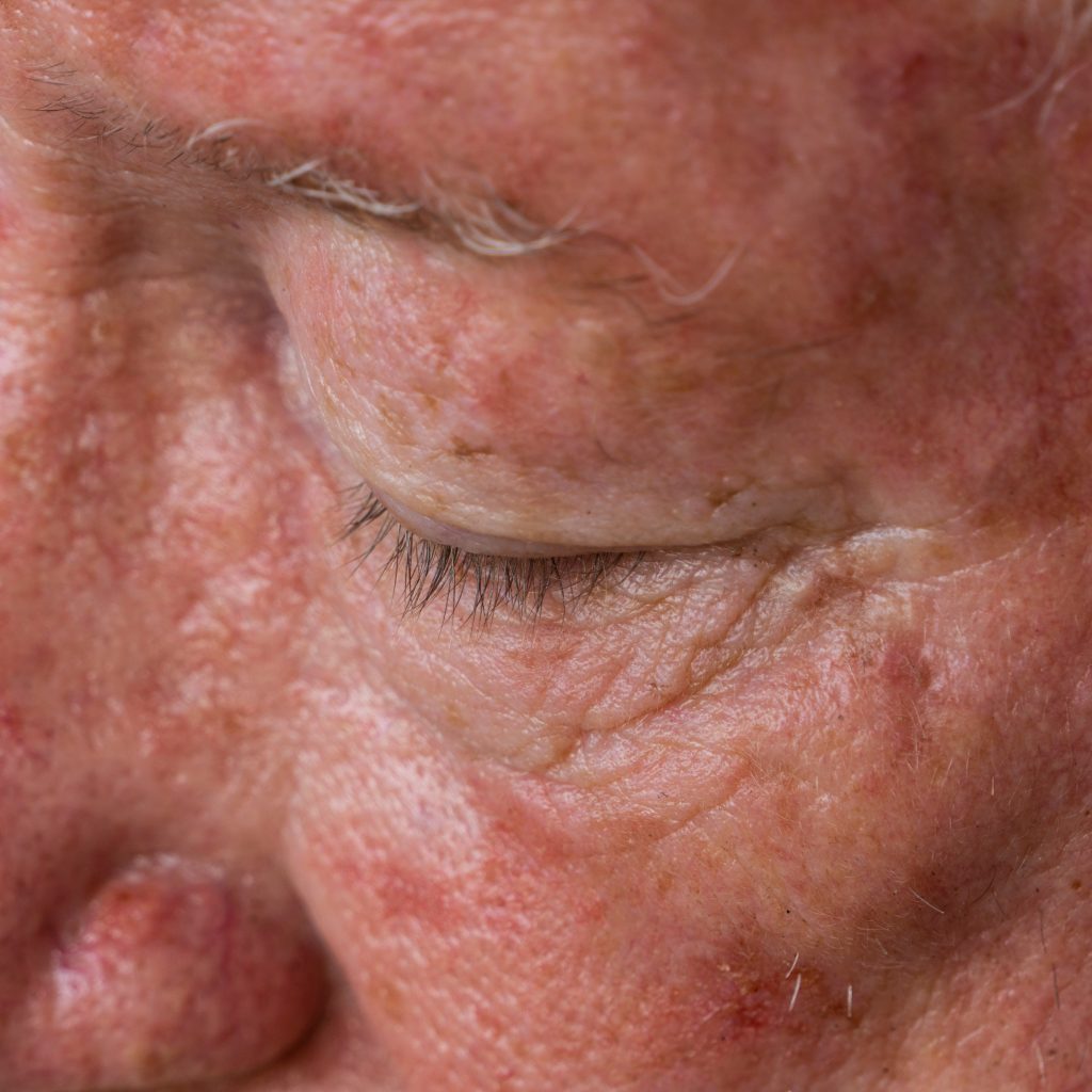 Photo shows the face of an elderly gentleman with sun damaged skin.