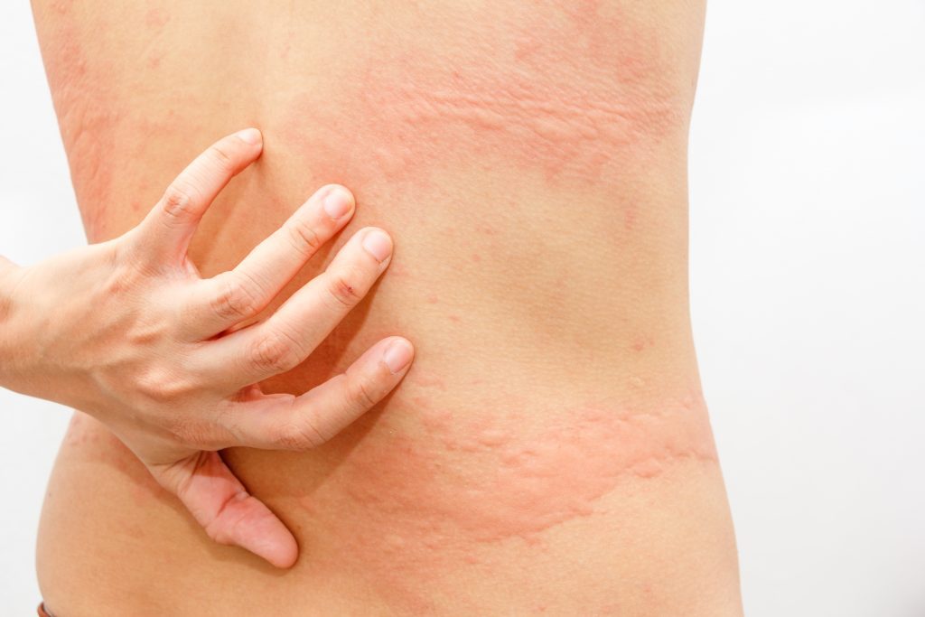 Photo shows Urticaria with typical Hives on the back and scratch marks from itching.