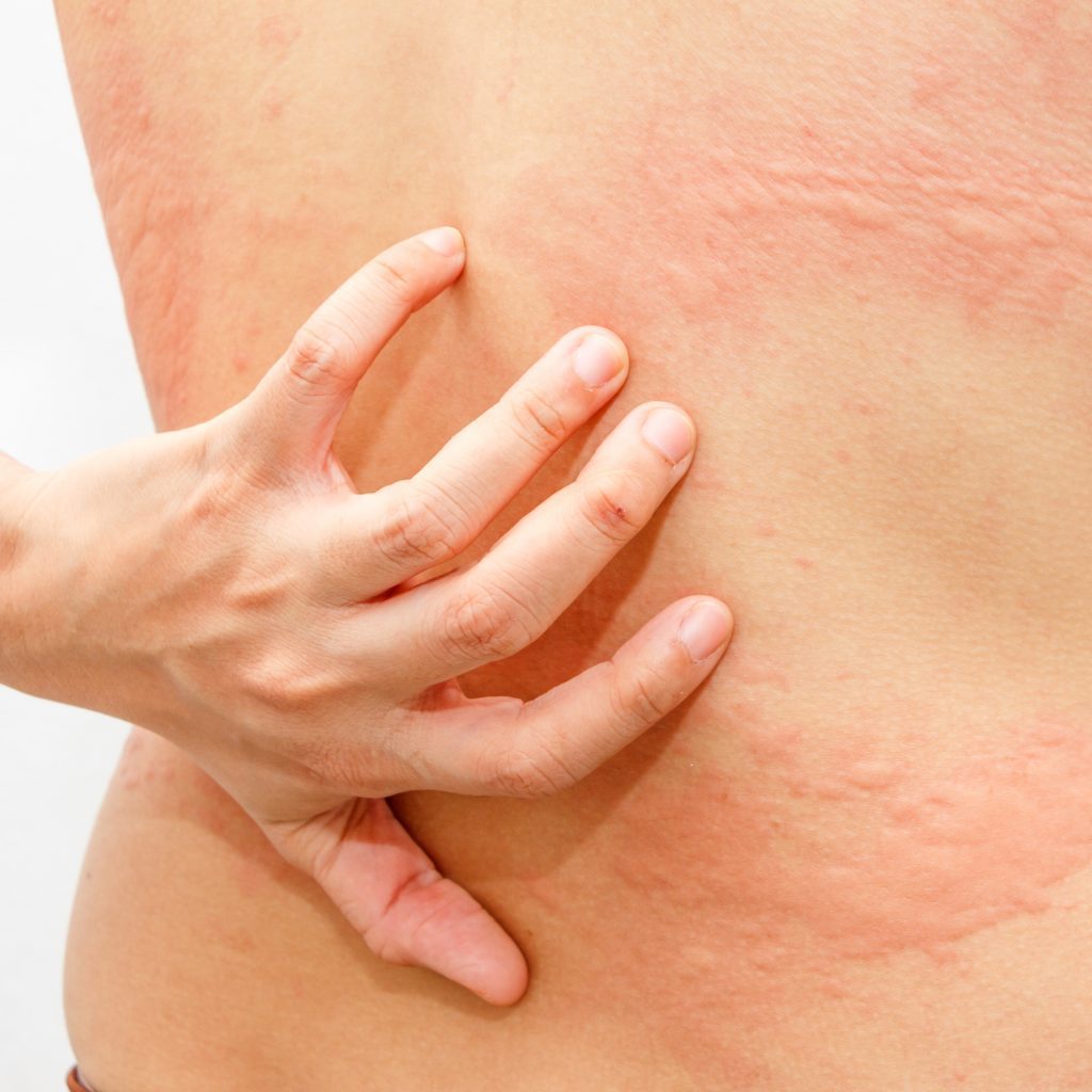 Urticaria with a typical rash on a woman's back with hives prior to receiving treatment for this common skin condition with leading skin doctor Dr Jonathan Slater in Sussex.