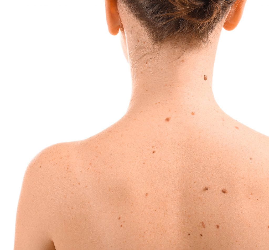 The back of a young lady with moles prior to receiving a full body mole check.