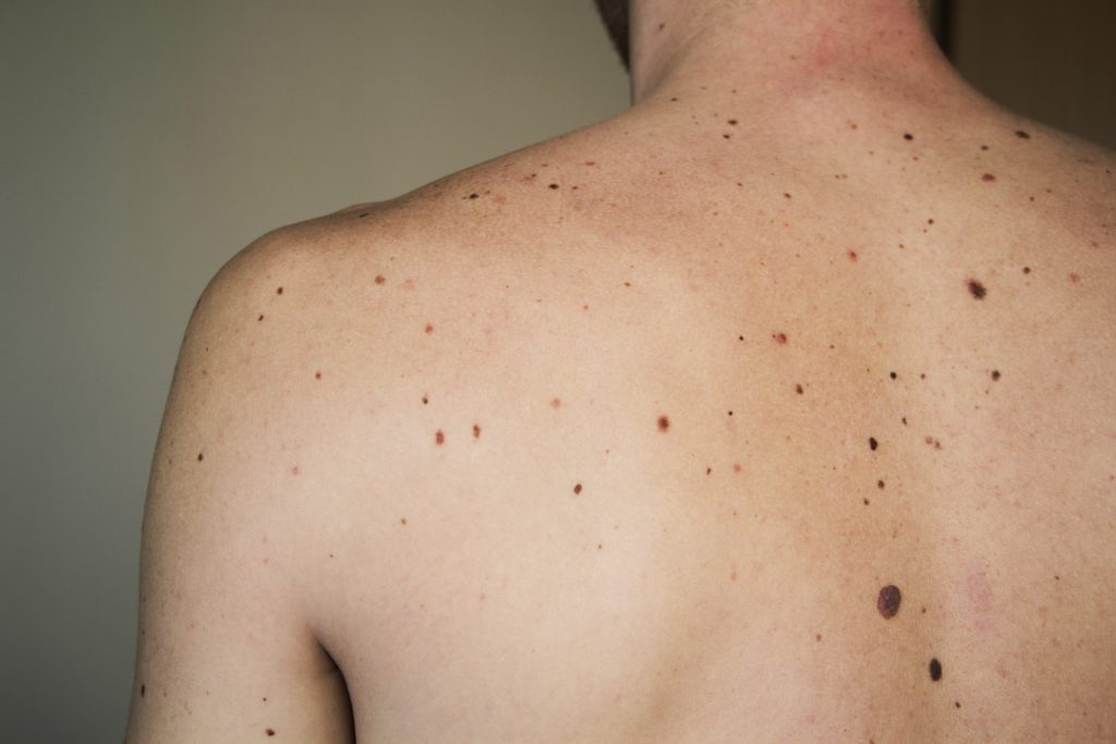 Photo shows a man with various large brown moles on his back prior during a full body mole check.